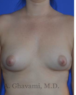 Fat Transfer To Breast Before & After Patient #8265