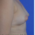 Fat Transfer To Breast Before & After Patient #8265