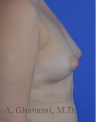Fat Transfer To Breast Before & After Patient #8265