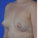 Fat Transfer To Breast Before & After Patient #8265
