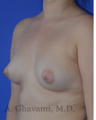 Fat Transfer To Breast Before & After Patient #8265