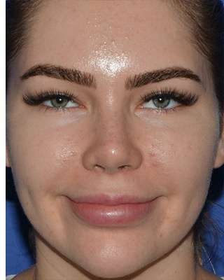Jawline Contouring Before & After Patient #7485