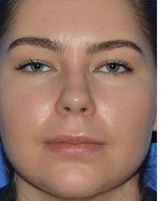 Jawline Contouring Before & After Patient #7485