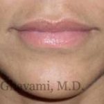 Lip Augmentation Before & After Patient #7482