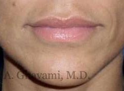 Lip Augmentation Before & After Patient #7482