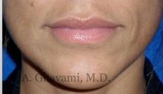 Lip Augmentation Before & After Patient #7482