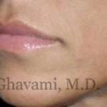 Lip Augmentation Before & After Patient #7482