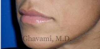 Lip Augmentation Before & After Patient #7482