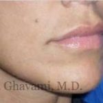 Lip Augmentation Before & After Patient #7482