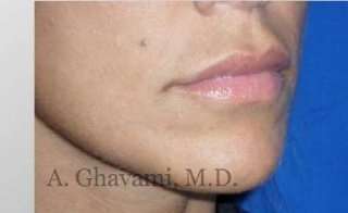 Lip Augmentation Before & After Patient #7482