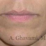 Lip Augmentation Before & After Patient #7482