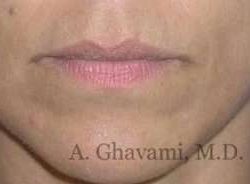Lip Augmentation Before & After Patient #7482