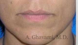 Lip Augmentation Before & After Patient #7482