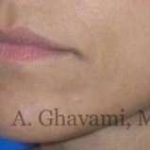 Lip Augmentation Before & After Patient #7482