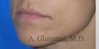 Lip Augmentation Before & After Patient #7482