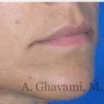 Lip Augmentation Before & After Patient #7482