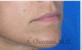 Lip Augmentation Before & After Patient #7482