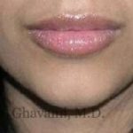 Lip Augmentation Before & After Patient #7475