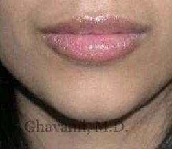 Lip Augmentation Before & After Patient #7475