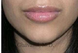 Lip Augmentation Before & After Patient #7475