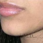 Lip Augmentation Before & After Patient #7475