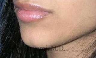 Lip Augmentation Before & After Patient #7475