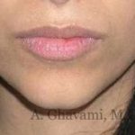 Lip Augmentation Before & After Patient #7475