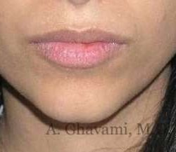 Lip Augmentation Before & After Patient #7475