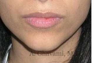 Lip Augmentation Before & After Patient #7475