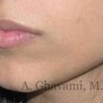 Lip Augmentation Before & After Patient #7475