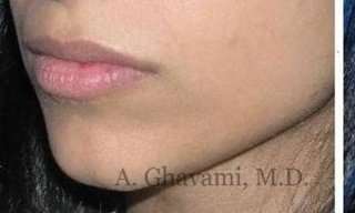 Lip Augmentation Before & After Patient #7475