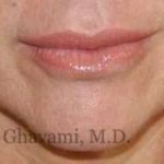 Lip Augmentation Before & After Patient #7470