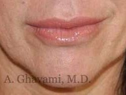 Lip Augmentation Before & After Patient #7470