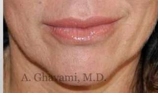 Lip Augmentation Before & After Patient #7470