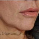 Lip Augmentation Before & After Patient #7470