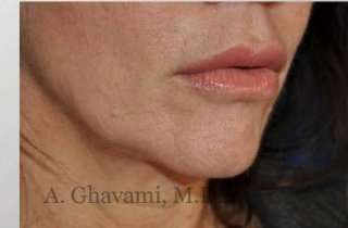 Lip Augmentation Before & After Patient #7470