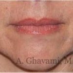 Lip Augmentation Before & After Patient #7470