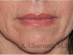 Lip Augmentation Before & After Patient #7470