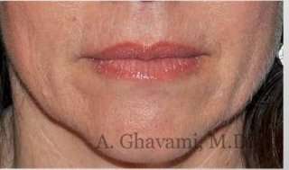 Lip Augmentation Before & After Patient #7470