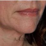Lip Augmentation Before & After Patient #7470