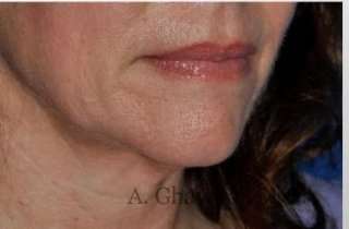 Lip Augmentation Before & After Patient #7470