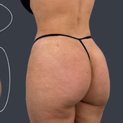 Liposuction Before & After Patient #7465