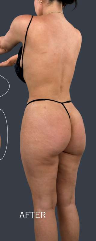 Liposuction Before & After Patient #7465
