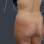 Liposuction Before & After Patient #7465