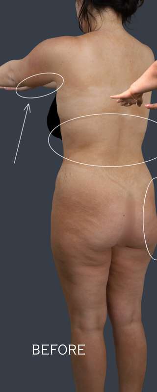 Liposuction Before & After Patient #7465