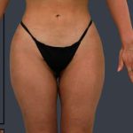 Liposuction Before & After Patient #7462