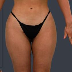 Liposuction Before & After Patient #7462