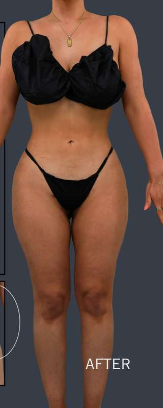 Liposuction Before & After Patient #7462