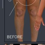Liposuction Before & After Patient #7462