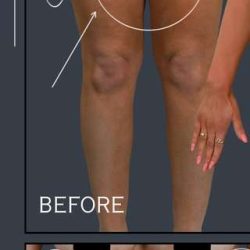 Liposuction Before & After Patient #7462